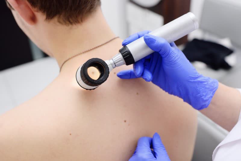 Dermatologa che visualizza melanoma con lente di ingrandimento